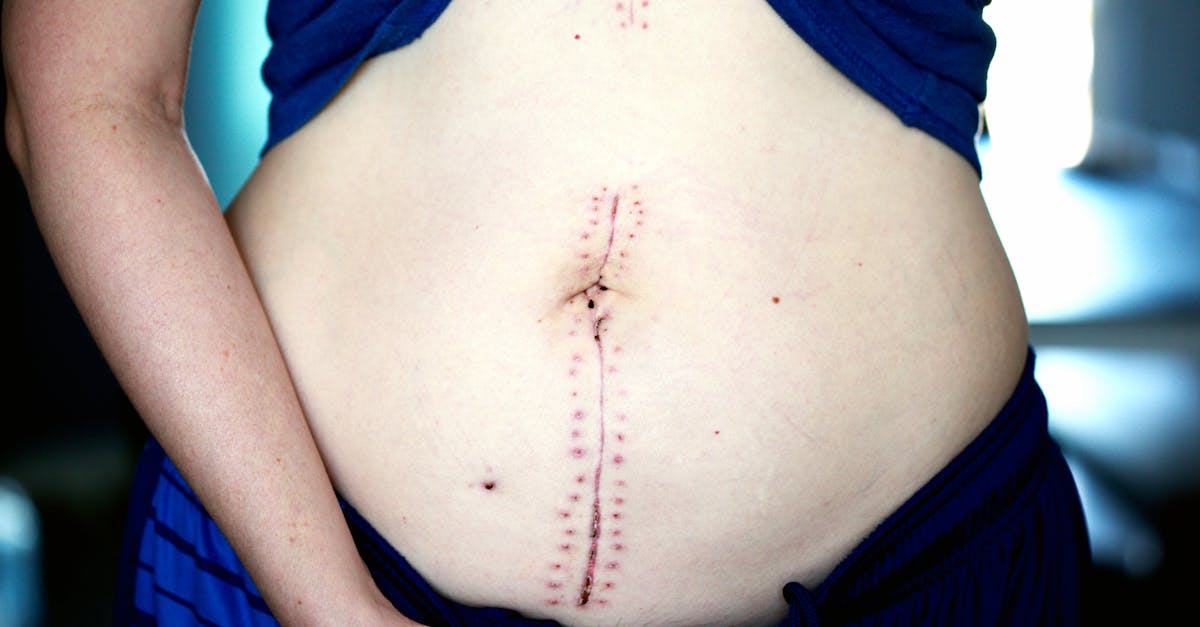 Recipes For Post Surgery